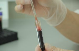 Blood Analysis in a Medical Laboratory | Breast Cancer Car Donations