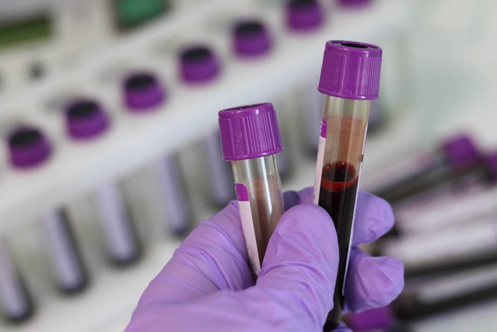 Blood Samples in the Laboratory | Breast Cancer Car Donations